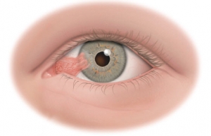 Pterygium